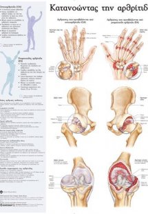 Ανατομικός Χάρτης: Κατανοώντας την αρθρίτιδα