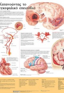 Ανατομικός χάρτης: Κατανοώντας το εγκεφαλικό επεισόδιο