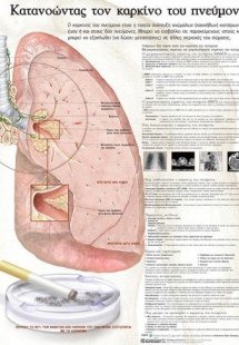 Ανατομικός χάρτης: Κατανοώντας τον καρκίνο του πνεύμονα