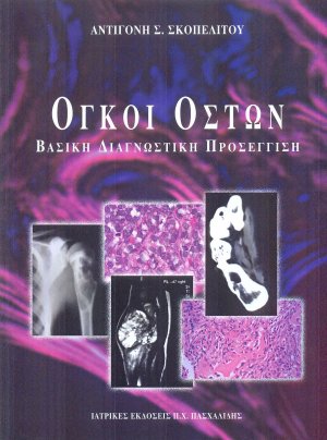 Όγκοι οστών