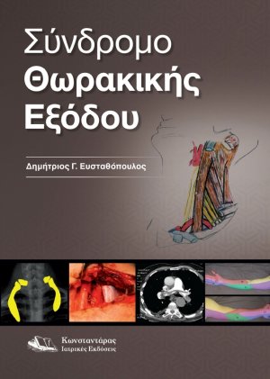Σύνδρομο Θωρακικής Εξόδου