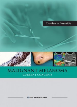 Malignant Melanoma Current Concepts