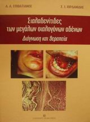 Σιαλαδενίτιδες των μεγάλων σιαλογόνων αδένων